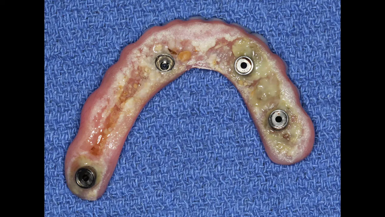 Imagine clinică cu resturi alimentare vizibile sub o proteză concavă