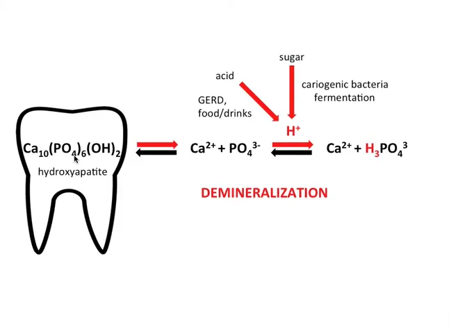 pata albă la suprafața smalțului ca semn de demineralizare