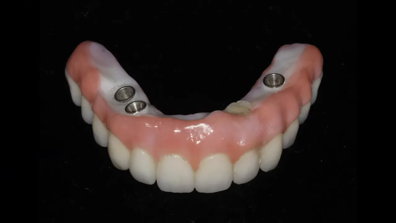 Proteză All-On-4 cu profil concav sub suprafață, greu de curățat